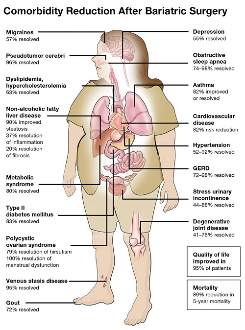 Comorbidity Reduction After Bariatric Surgery